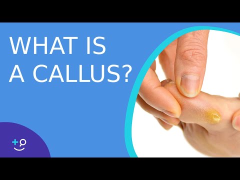 What is a Callus? - Daily Do&#039;s of Dermatology
